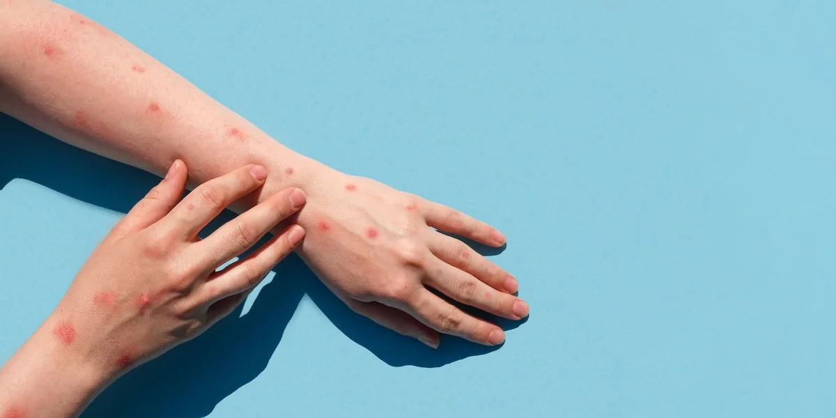 El preocupante brote de mpox: lo que debemos saber sobre la nueva cepa mortal