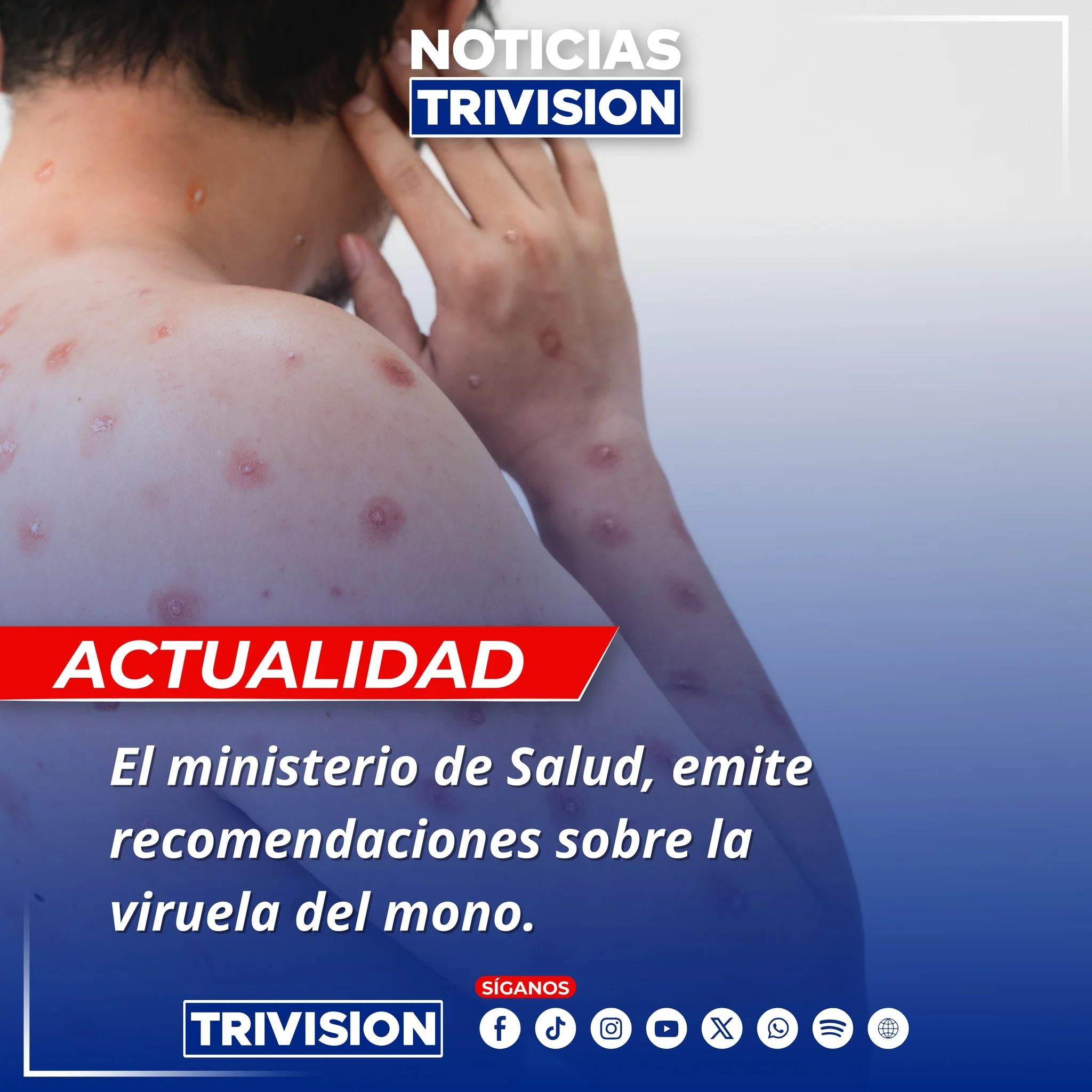 Ministerio de Salud de Costa Rica emite alerta por viruela símica